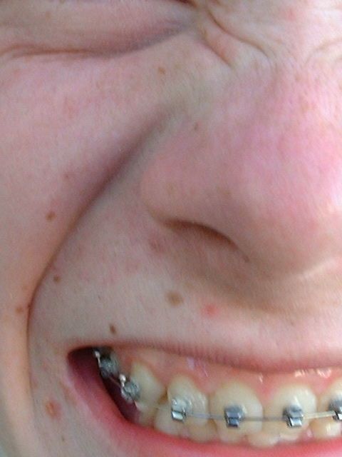 Picture Of Braces