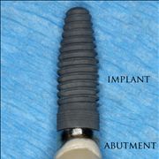 Picture Of Dental Implant With The Abutment And Crown Attached
