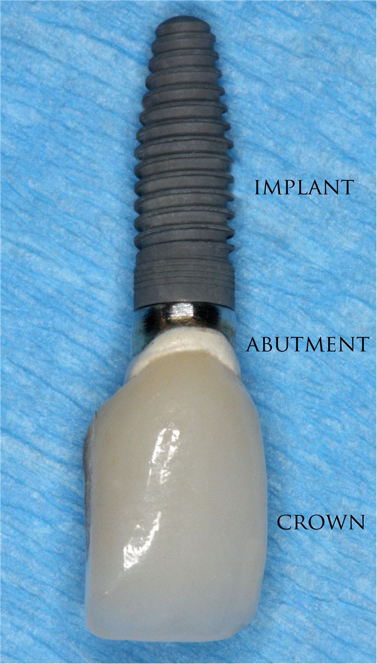 Picture Of Dental Implant With The Abutment And Crown Attached