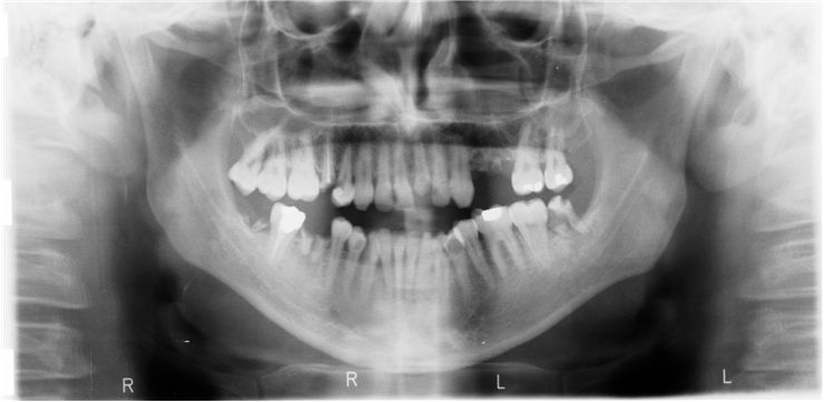 Picture Of Mouth Radiography Broken Tooth