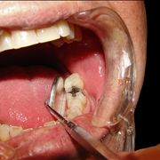 Picture Of Picture Of Dental Procedure