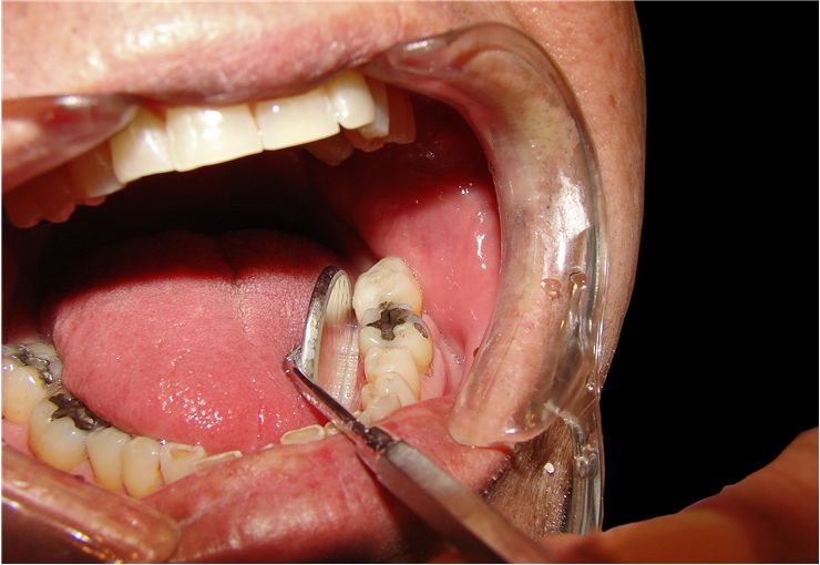 Picture Of Picture Of Dental Procedure