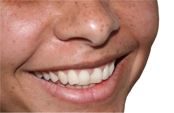 Picture Of Smile Teeth
